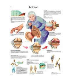 Poster anatomico artrosi