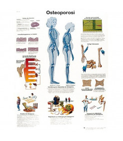 Tavola anatomica osteoporosi